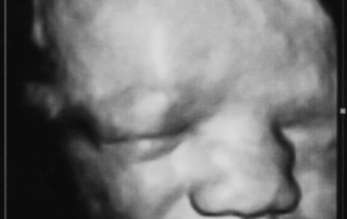 fetus ultrasound